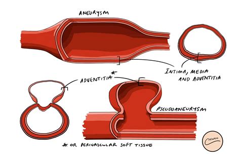 pseudoaneurysm vs true aneurysm